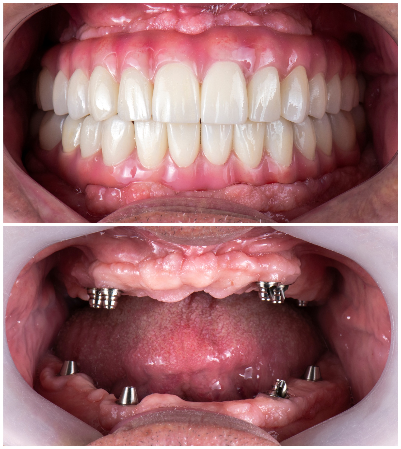 Réhabilitation complète All-on-6 implants dentaires