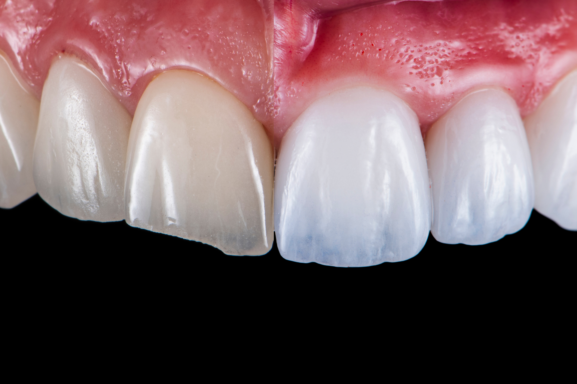 Facettes dentaires céramiques - sourire transformé